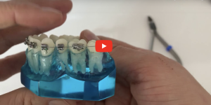 Que faire si un boitier orthodontique se casse et que ça gêne?