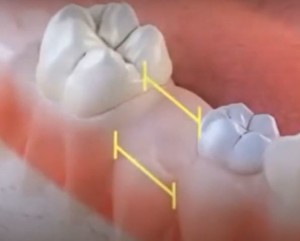 Comment maintenir un espace dentaire ?