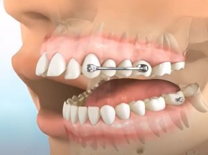 Carrière et Broches orthodontie