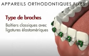 38 appareils orthodontiques fixes