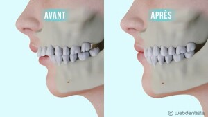 La chirurgie orthognatique – Rétrognathie mandibulaire